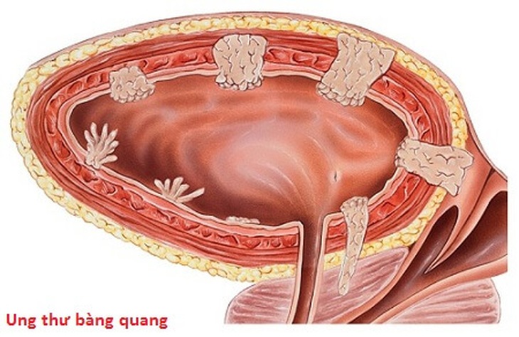 UT bàng quang là 1 trong 7 loại UT thường gặp.